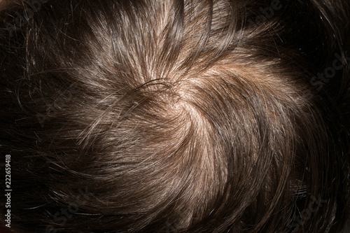 Hair On The Head Of A Man Thin Brittle Rare Prollysiny For