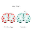  primary generalized epilepsy and focal seizures