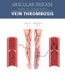 Vascular diseases. Vein thrombosis symptoms, treatment icon set. Medical infographic design