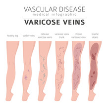 Vascular Diseases. Varicose Veins Symptoms, Treatment Icon Set. Medical Infographic Design