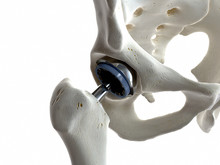 3d Rendered Medically Accurate Illustration Of A Hip Replacement