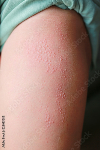 Close Up Allergic Rash Dermatitis Eczema On Skin Buy This Stock Photo And Explore Similar Images At Adobe Stock Adobe Stock