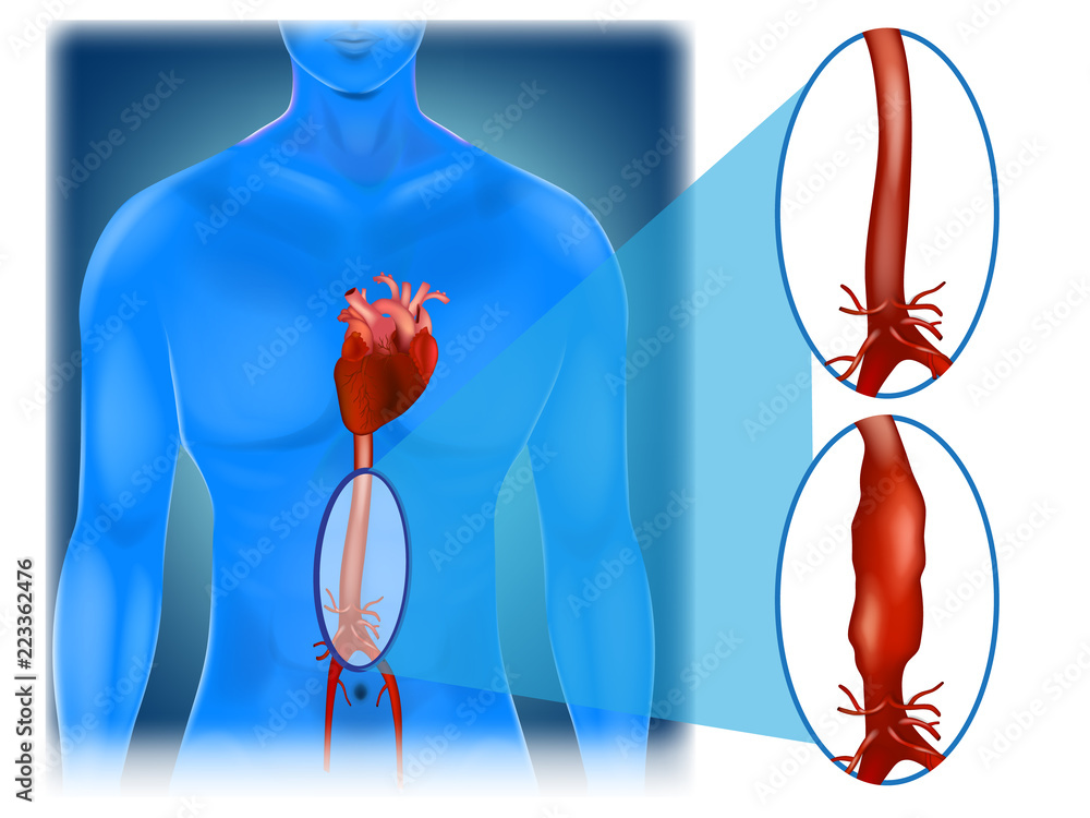 Abdominal aortic aneurysm - location and appearance. Stock Vector ...