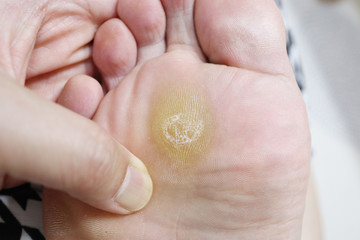 skin callus