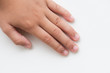 © Siam - Close up child's fingers with dry skin, Eczema Dermatitis. Medicine and health care concept.