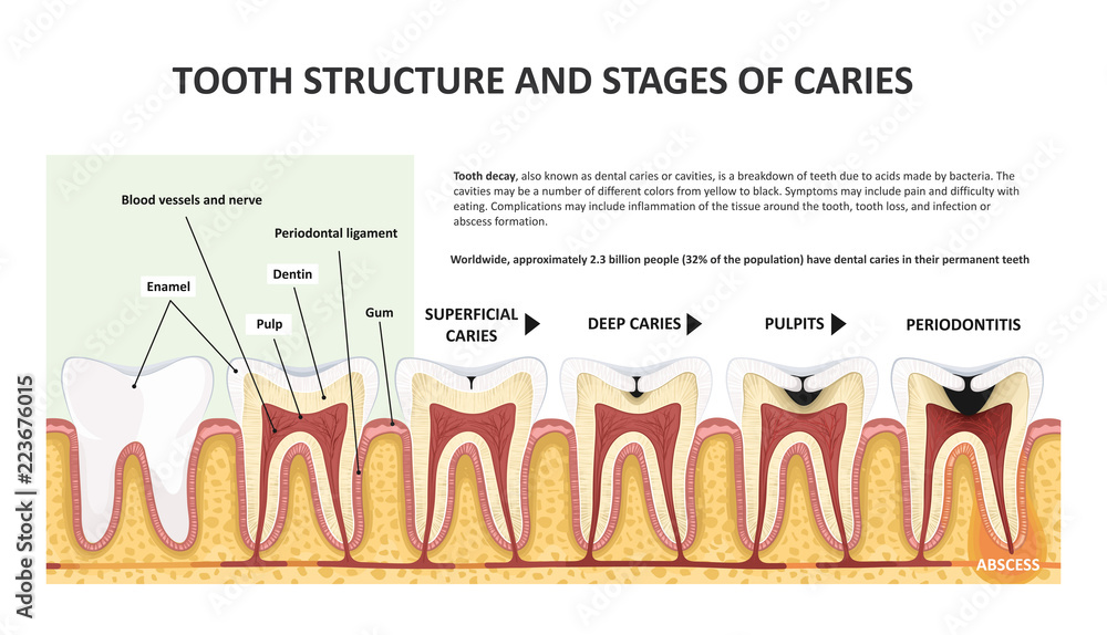 Tooth structure and stages of caries Stock Vector | Adobe Stock