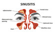 Sinusitis. Healthy and inflammation nasal sinus