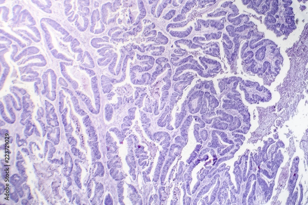 Squamous Cell Microscope Esophageal squamous cell carcinoma, light micrograph, photo under ...