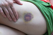 A teenager girl show a big purple bruise on her left leg.