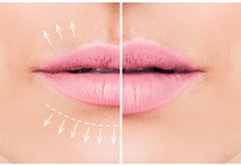Beautiful Pink Lips Before And After Filler Injection Collagen To Increase The Volume Of The Lips. Beauty Concept. Female Lips, Augmentation Procedure