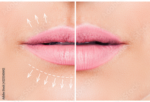 Fotomural Beautiful pink lips before and after filler injection collagen to increase the volume of the lips