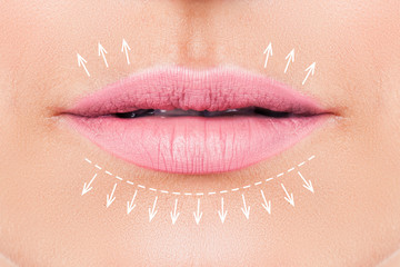 Wall Mural - Woman lips before filler injections. Fillers. Lip augmentation