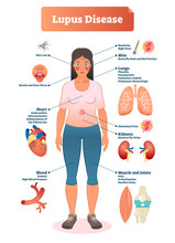Lupus Disease Vector Illustration. Labeled Diagram With Sickness Symptoms.