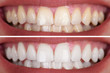 Woman's Teeth Before And After Whitening