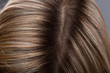 Dandruff In Woman's Hair