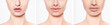 © Peakstock - set lips after botulinum Toxin Injection, lip augmentation procedure and set beautiful perfect lips