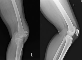 Lateral view of knee patella 
