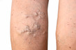 varicose veins on female leg isolated on white background 