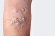 © doucefleur - varicose veins on female leg skin closeup