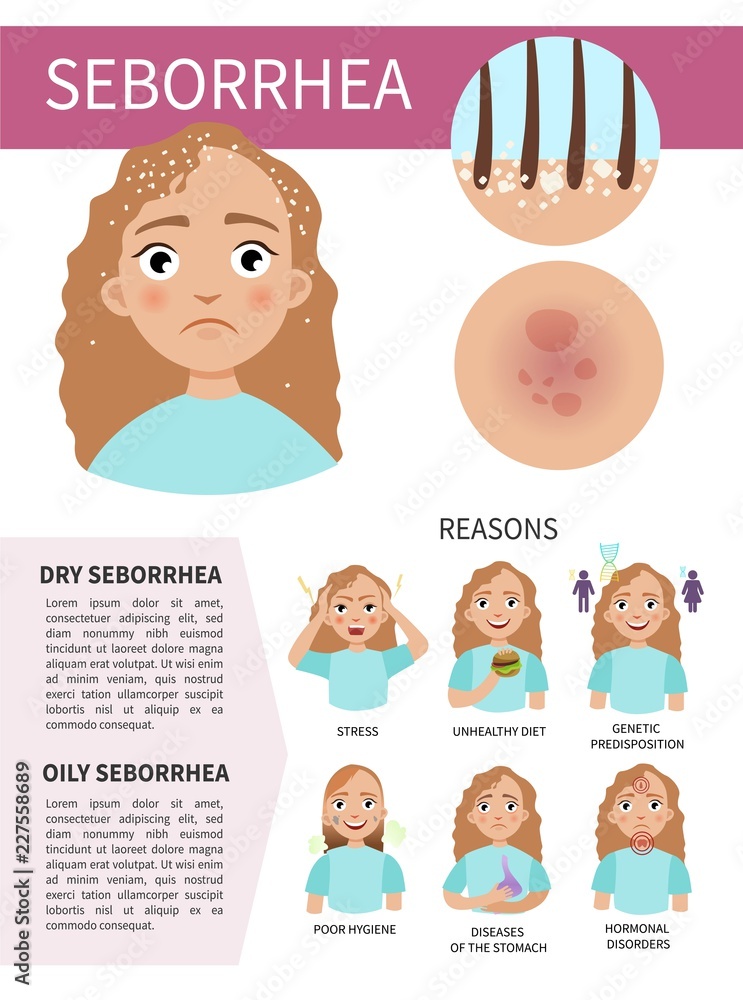 Infographics of seborrhea. Problems with hair and skin. Illustration of a cute girl. Causes of the appearance of the disease.