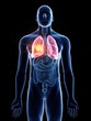 © Sebastian Kaulitzki - 3d rendered medically accurate illustration of a mans lung cancer