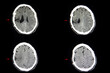 CT scan cerebro malacia