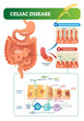 Celiac disease vector illustration. Labeled diagram with its structure