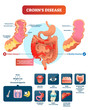 © VectorMine - Crohns disease vector illustration. Labeled diagram with diagnosis.