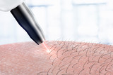 Fototapeta Sypialnia - cosmetology procedure laser hair removal on body parts. Laser epilation.