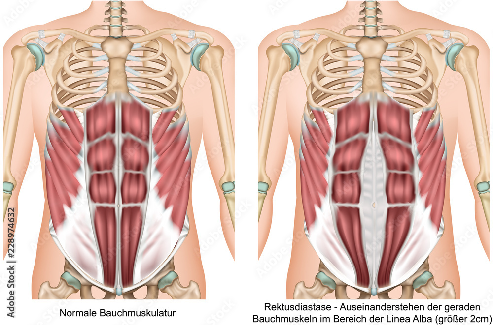 Rektusdiastase Anatomie Bauchmuskeln vektor illustration - obrazy, fototapety, plakaty 