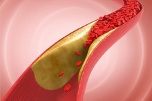 Blood Cells With Plaque Buildup Of Cholesterol 3d Illustration.