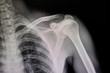 Xray film of a patient with hairline fracture of clavicle.