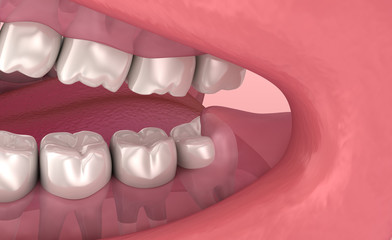 Wall Mural - Wisdom tooth problem. Medically accurate tooth 3D animation