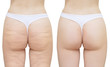 © Iuliia Alekseeva - Cellulite on the buttocks and thighs. White isolate. Before and after
