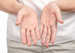 © Kabardins photo - Female hands psoriasis on a white background. Isolation