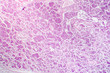 Lobar pneumonia, grey hepatic phase
