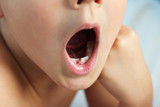 Fototapeta  - niño enseñando la boca con el hueco que ha dejado el diente de leche y detrás ya está el definitivo