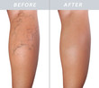 woman leg with varicose veins before and after