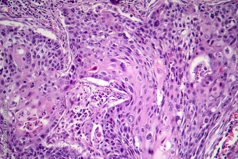 Squamous cell carcinoma of the lung Stock Photo | Adobe Stock