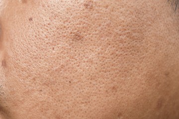 pores and oily on surface young asian man face skin do not take care for a long time