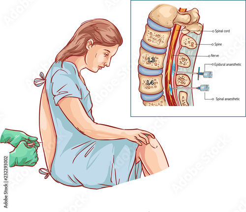 Fotomural Epidural Nerve Block Injection