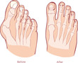 © corbacserdar - Human foot deformity. Hallux Valgus and tailors bunion.