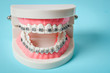 © gamjai - tooth model with metal wire dental braces.