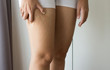 Woman with cellulitis on leg excess and overweight fatty