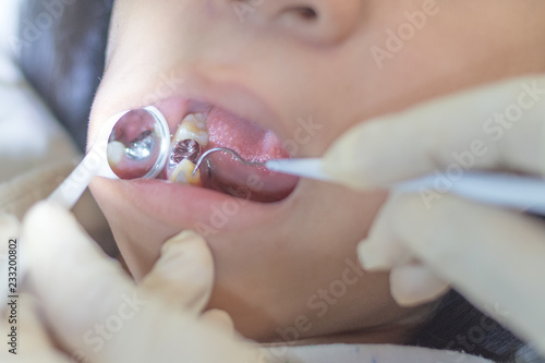 Fotografia, Obraz Silver amalgam crown dental filling in mouth with dentist' hands using mirror and equipment to do teeth cleaning