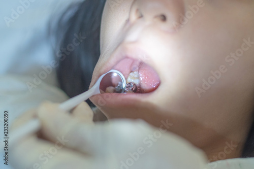 Fotografija Silver amalgam crown dental filling in mouth with dentist' hands using mirror and equipment to do teeth cleaning