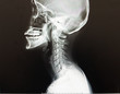 Normal cervical spine of a girl, X-ray Cervical spine after had an adcident.