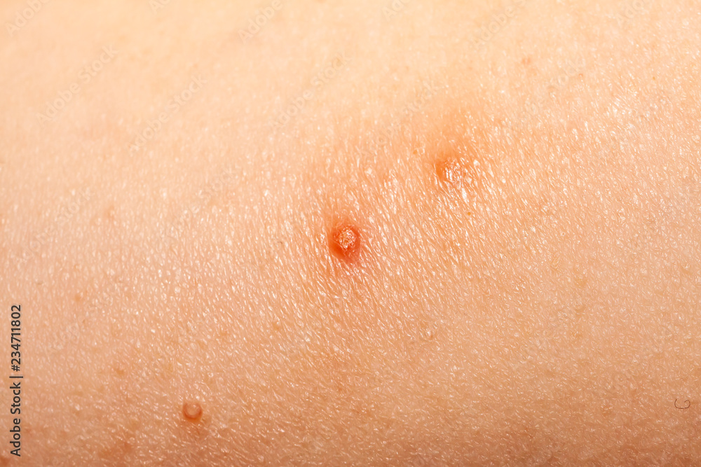 Close up of Molluscum Contagiosum also called water wart