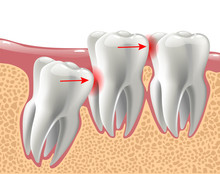 Realistic 3D Teeth, And Wisdom Tooth Problems