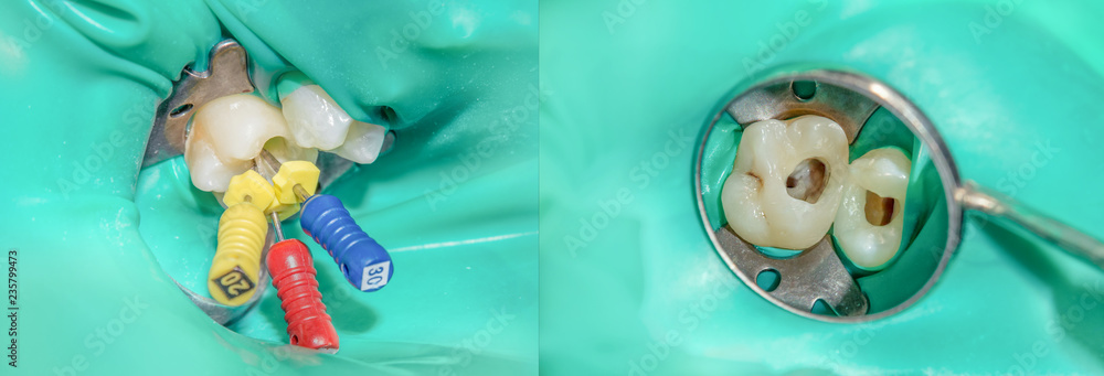 photo endodontic treatment of dental canals in the lower molar permanent tooth molar with endodontic file with apex locator - obrazy, fototapety, plakaty 